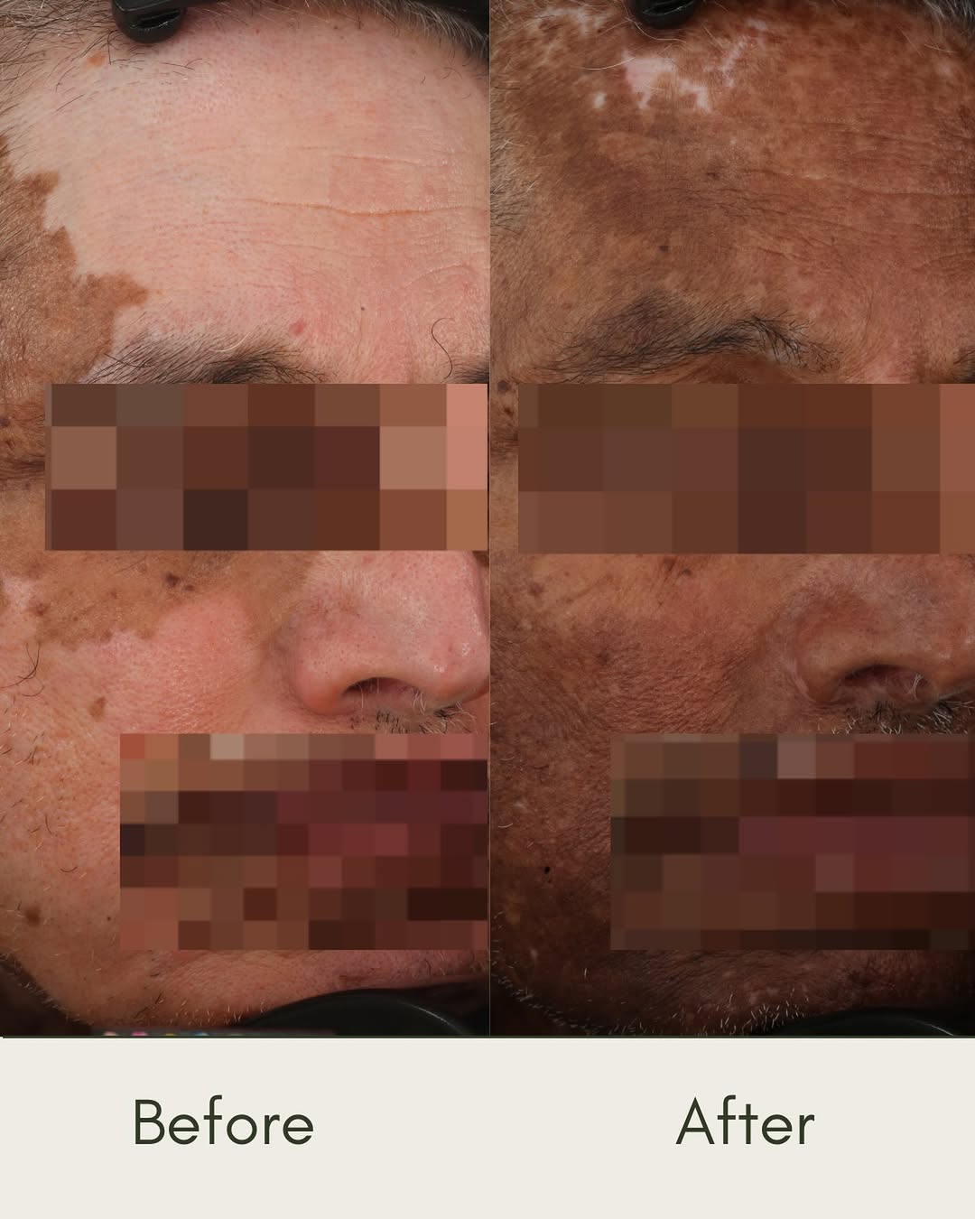 Instagram post by Dr. Pearl E. Grimes: Progress in vitiligo treatment continues to give us so much reason for hope. 💜 This patient’s before-and-after results demonstrate signific…