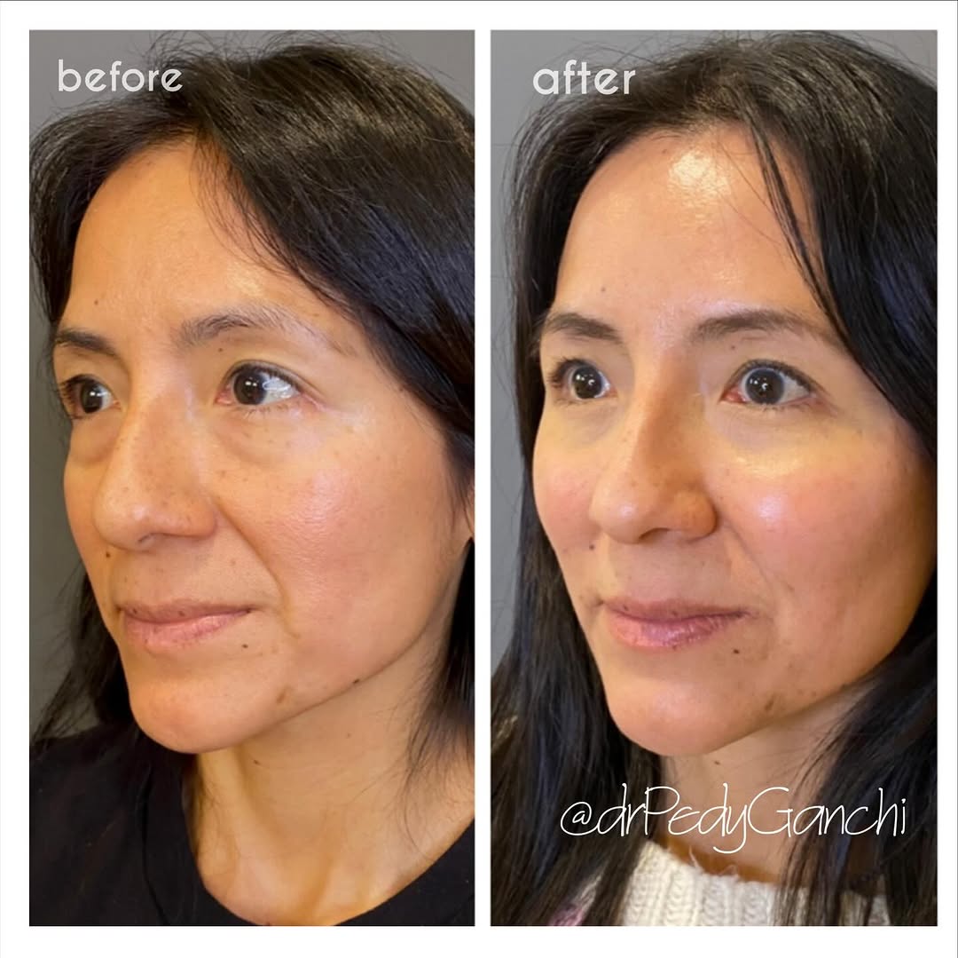 Instagram post by Dr. Pedy Ganchi: A closer look at our lovely 43 year old mom who is now energized, refreshed & #natural 🌸 . Lower #eyebags were carefully removed via #bleph…