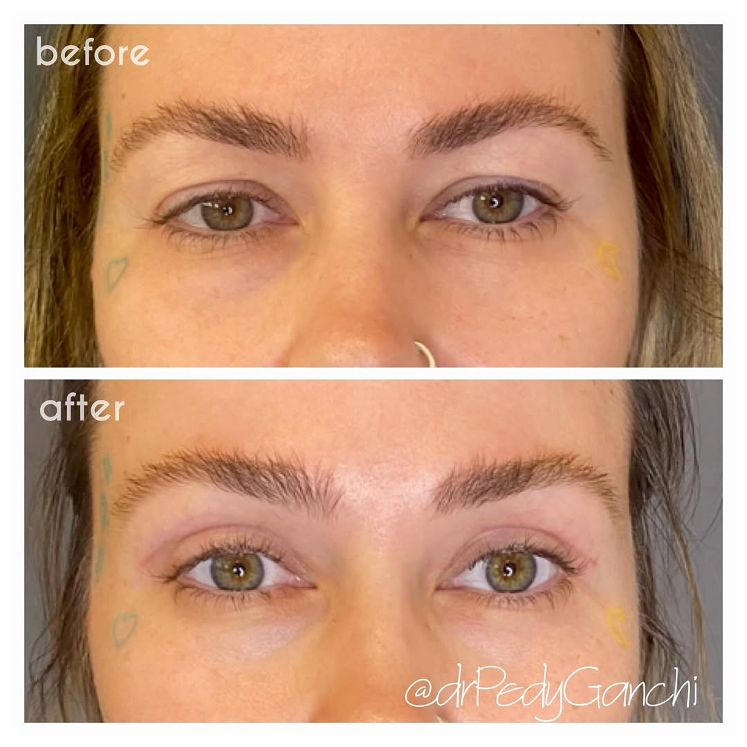 Instagram post by Dr. Pedy Ganchi: #EyelidSurgery or #Blepharoplasty for bright, alert, refreshed, youthful eyes✨✨ a surgery that’s trending younger as with my beautiful 35 ye…