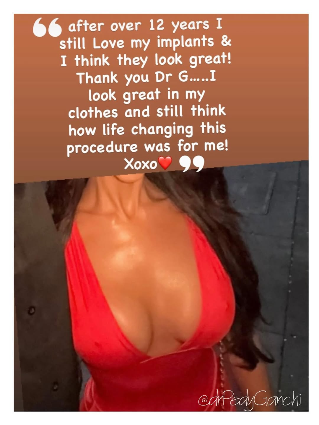 Instagram post by Dr. Pedy Ganchi: I love hearing from #HappyPatients , especially years after their procedure!❤️it’s nice to hear about the positive lasting impact plastic su…