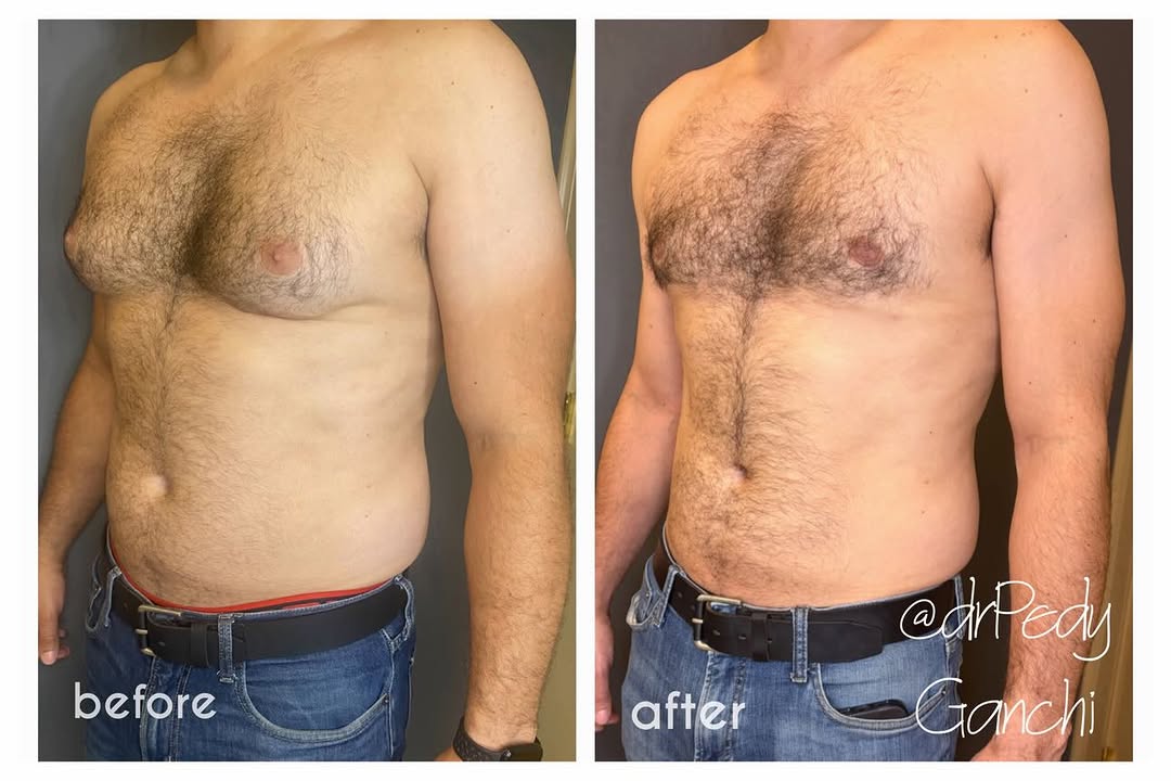 Instagram post by Dr. Pedy Ganchi: Now this transformation is ✨🤩✨ simply ideal! My 37 y/o patient needed a little boost in confidence and help with #gynecomastia or male brea…