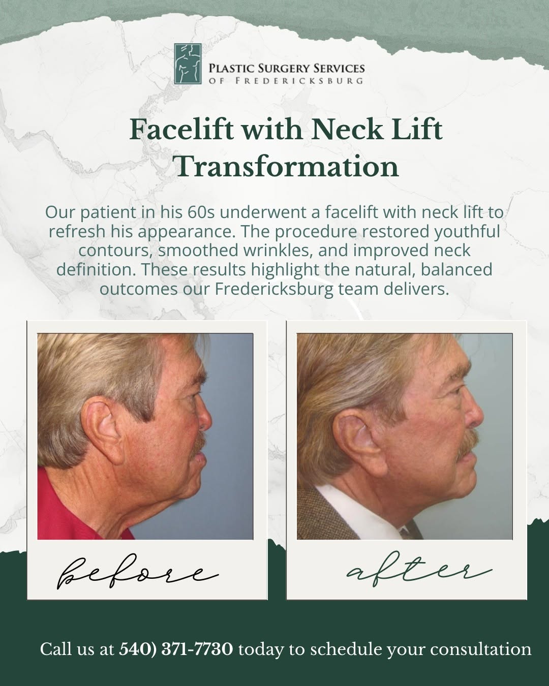 Instagram post by Dr. Pejman Aflaki: Seeing the results of a facelift with neck lift can be truly inspiring. ✨ This patient, in his 60s, trusted our team at Plastic Surgery Serv…