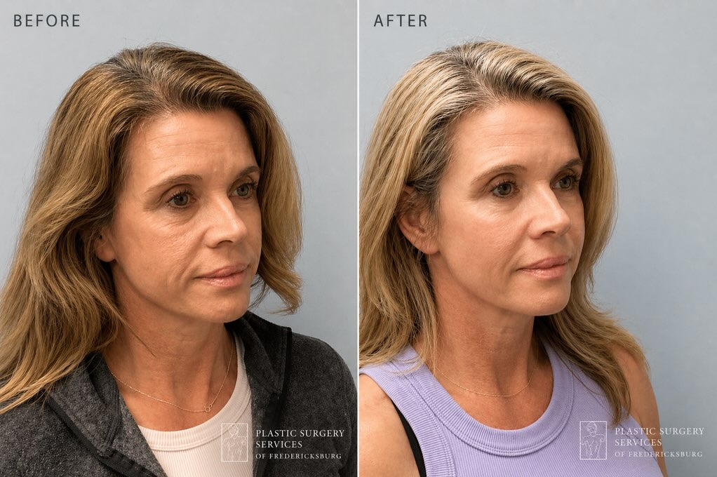 Instagram post by Dr. Pejman Aflaki: Subtle changes. Beautiful impact. ✨ The ideal midface procedure is designed to address the earliest signs of aging—restoring lost volume, en…