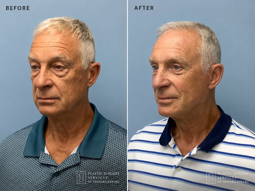 Instagram post by Dr. Pejman Aflaki: At Plastic Surgery Services of Fredericksburg , our doctors specialize in facial rejuvenation procedures designed to restore a more youthful…