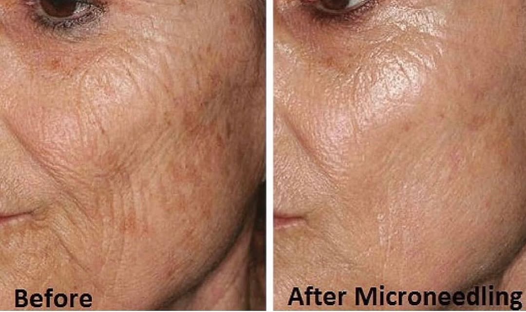 Instagram post by Dr. Peter Accetta: Microneedling before and after 4 treatments✨ Have you started your series yet? If you start now, your skin will be Summer ready in a few mon…