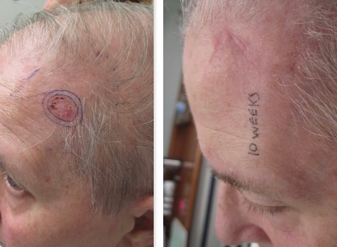 Instagram post by Dr. Peter Accetta: 10 weeks post excision🤯 Our primary focus in office is the treatment and prevention of skin cancer. This after photo was taken just 10 week…