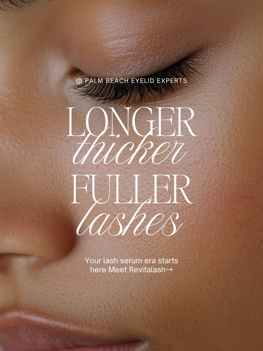 Instagram post by Dr. Peter A.D. Rubin: Your lashes, but better. If you know me, you know I’m all about results that look natural but elevated. RevitaLash is one of my favorite go-…