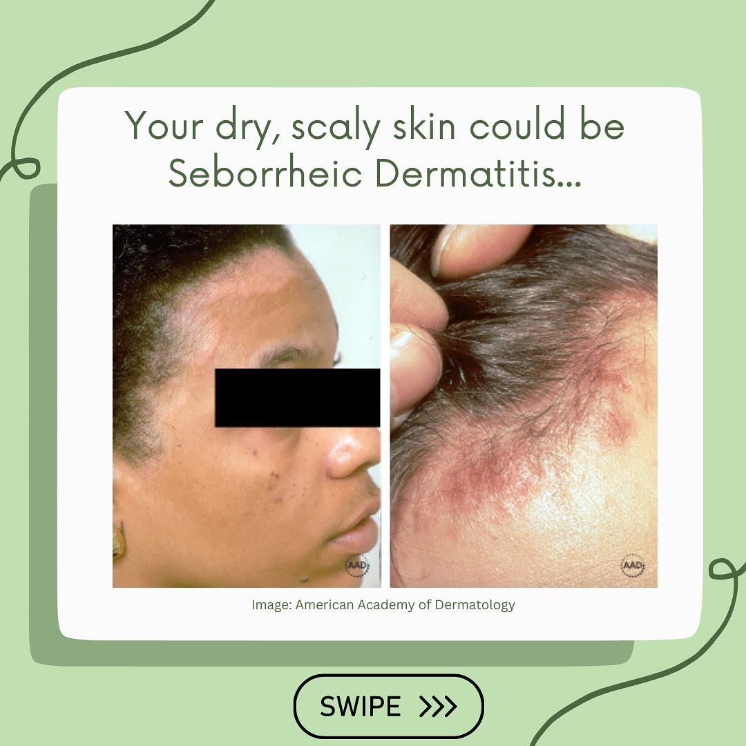 Instagram post by Dr. Peter Chien: Spring is around the corner which means many of you may be experiencing rashes, or dry, scaly skin, which could indicate a flare up of sebor…