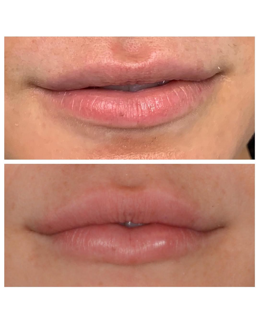 Instagram post by Dr. Peter Hyans: Creating the perfect pout 💉👄 #lips #lipfiller #perfectpout #plasticsurgery #plasticsurgeon #newjerseyplasticsurgery #summitmedicalgroup #b…