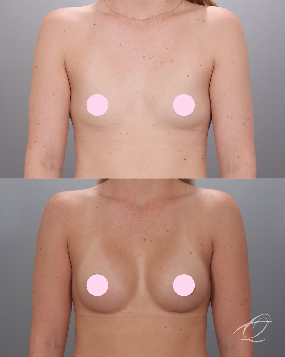 Instagram post by Dr. Peter Krasniak: The look she wanted? Natural. The result? Exactly that. Three months post-op and this augmentation is settling in beautifully. Our patient c…