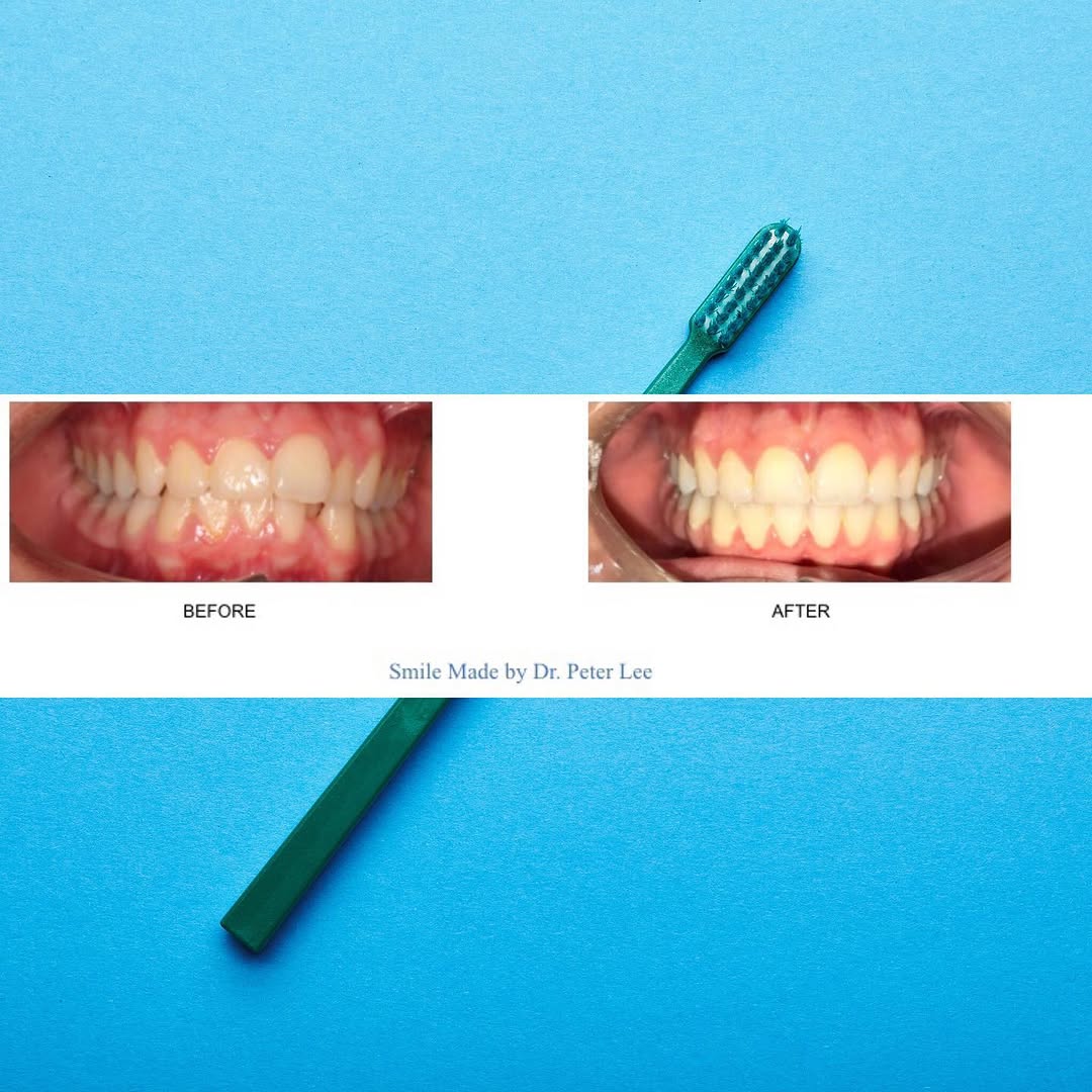 Instagram post by Dr. Peter Lee: A genuine smile comes from the heart, but a healthy smile needs good dental care! 😊 . . 🦷 🦷 🦷 😬 #braces #westcovinabraces #irvinebraces…