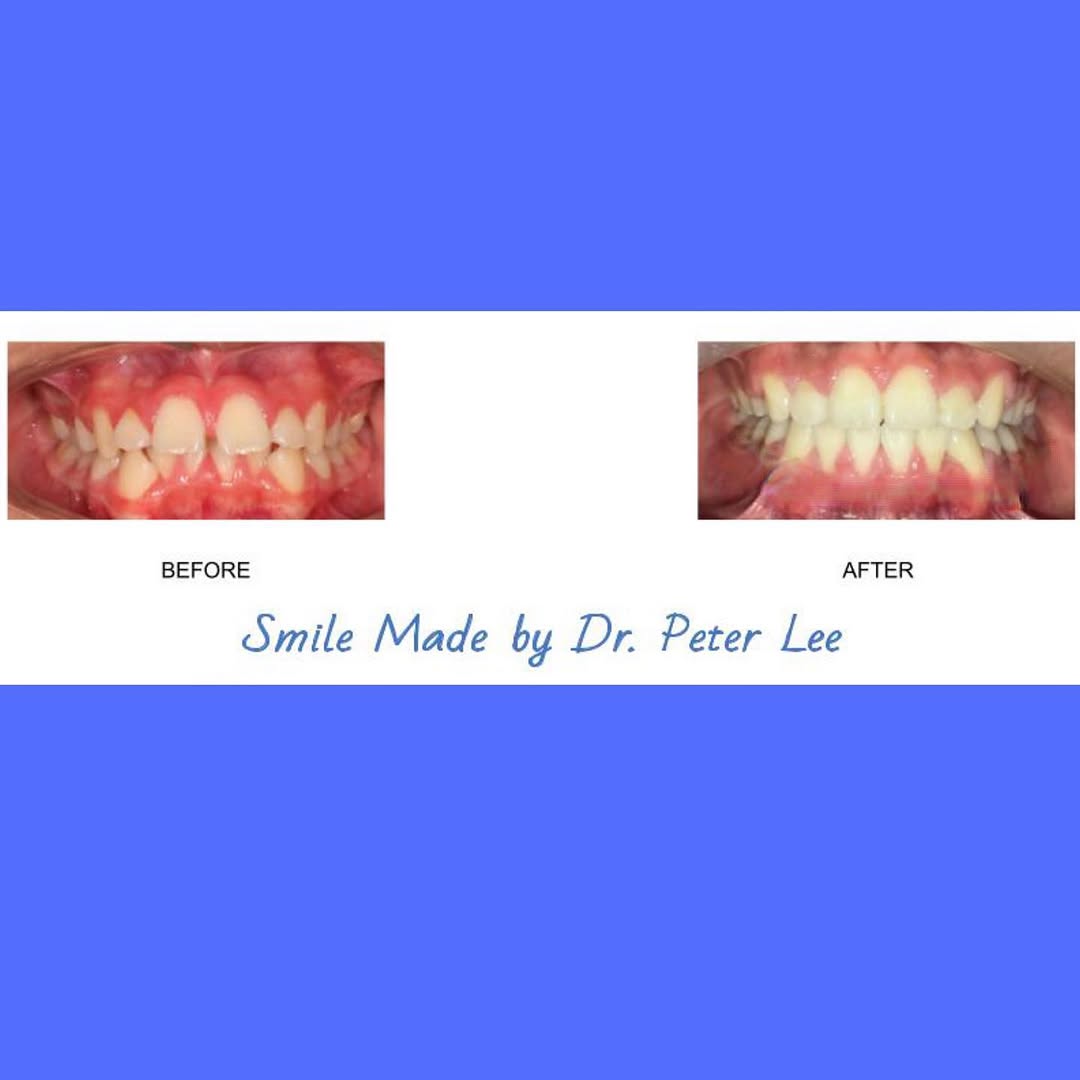 Instagram post by Dr. Peter Lee: Posting a #tbthursday ⭐️⭐️ Look at this amazing before & after! We love to see it! Awesome work Dr. Lee 👏🏻 Confidence is key! The greatest…