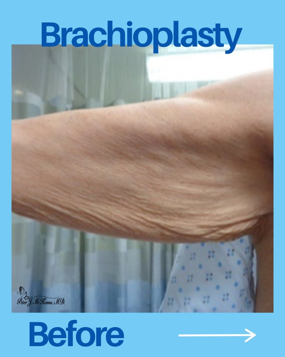 Instagram post by Dr. Peter McKenna: A closer look at a Before and After Brachioplasty 💙 - #brachioplastyresults #beforeafter #plasticsurgeon #ohio #naturalresults