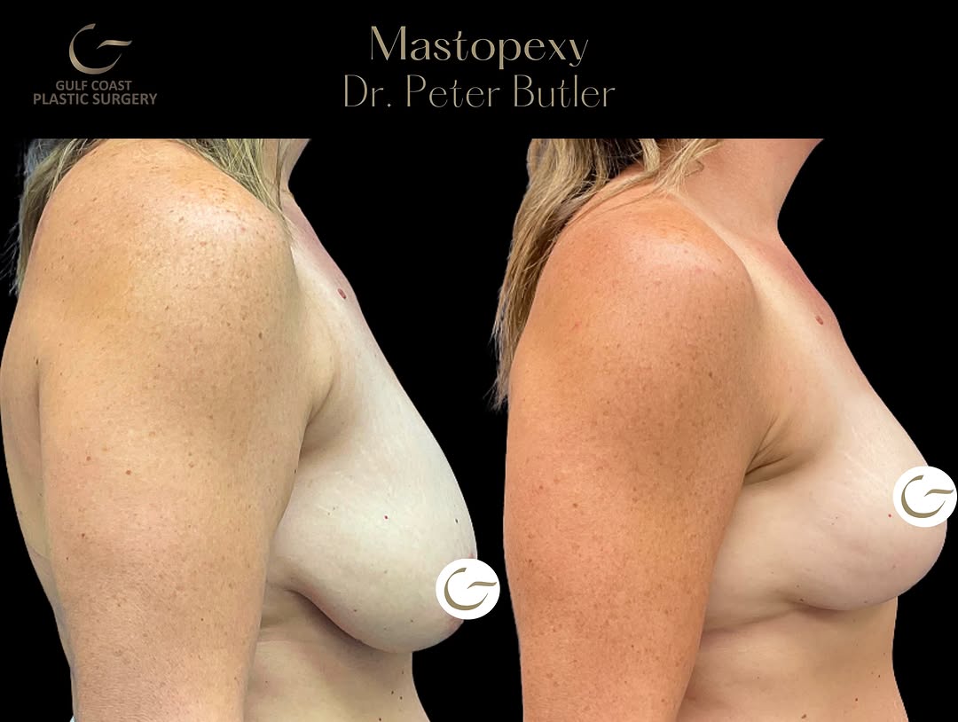 Instagram post by Dr. Peter N. Butler: Before & After | Breast Lift A breast lift, or mastopexy, is designed to lift and reshape the breasts by removing excess skin and reposition…