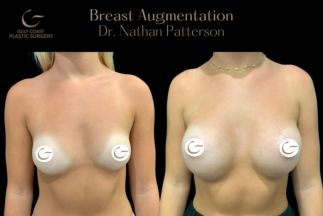 Instagram post by Dr. Peter N. Butler: Before & After | Breast Augmentation This breast augmentation was performed by Dr. Nathan Patterson to enhance volume and create a fuller, b…