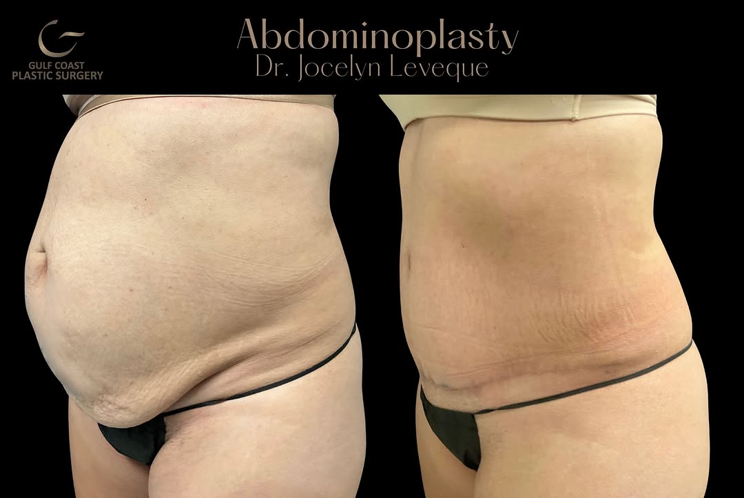 Instagram post by Dr. Peter N. Butler: Before & After | Tummy Tuck A dramatic transformation by Dr. Jocelyn Leveque. This tummy tuck addressed loose abdominal skin and helped crea…