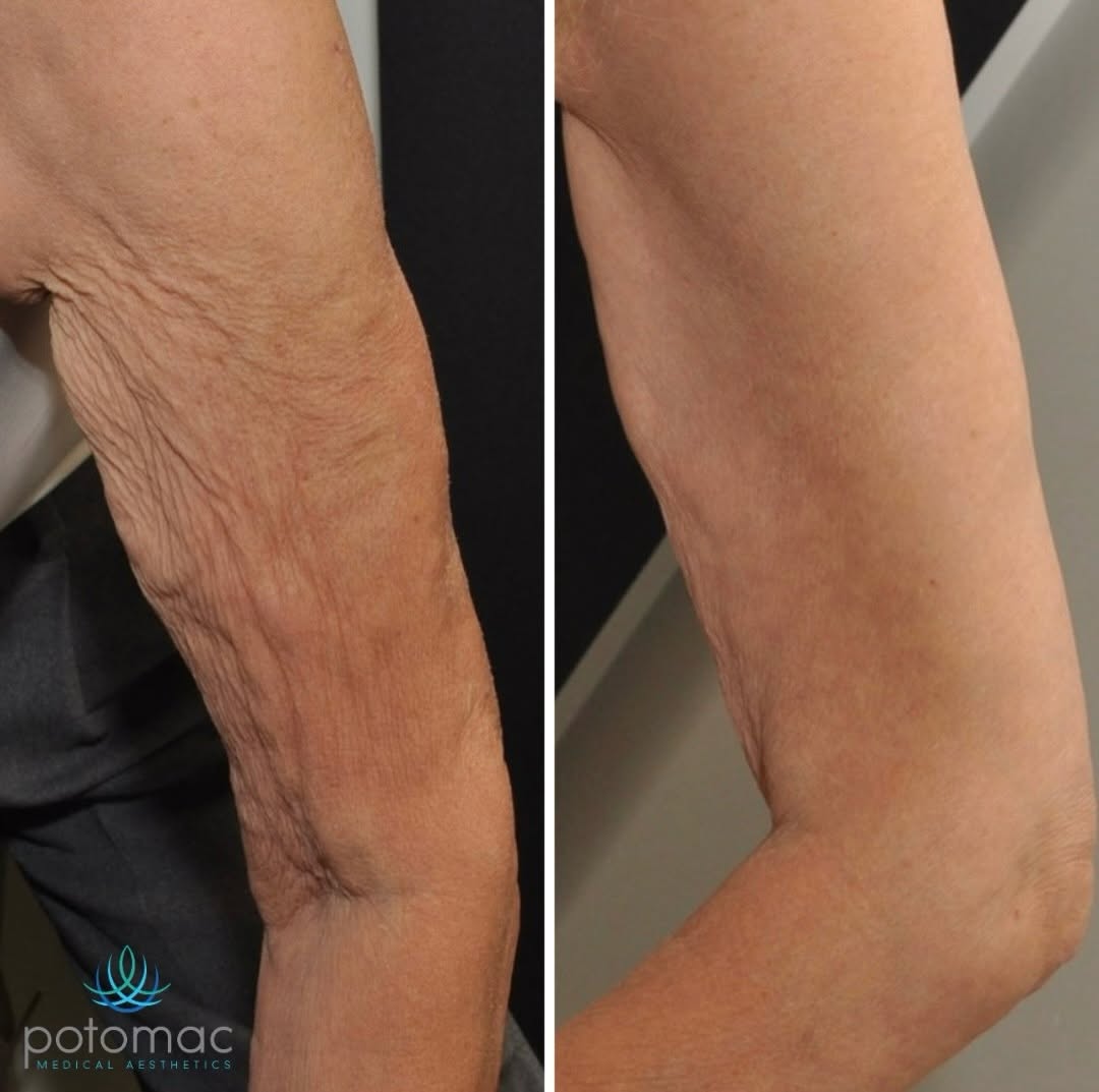 Instagram post by Dr. Peter Petropoulos: Real results, no filters! 😍 INDIBA treatments helped to tighten and contour arms, paired with TransFORM Body Treatment from Alastin Skincar…