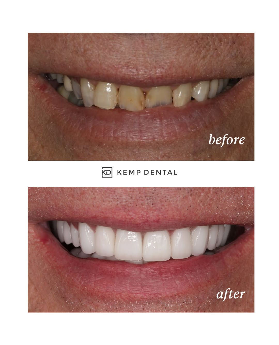 Instagram post by Dr. Phillip Kemp, DDS: Restore your smile to look like the best version of YOU!🦷 #KempDental #SmileTransformation