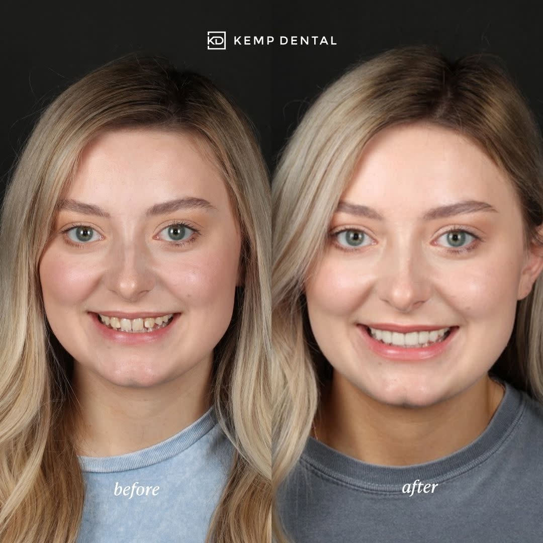 Instagram post by Dr. Phillip Kemp, DDS: A smile transformation that speaks for itself. ✨ From the first appointment to the final reveal, our goal is to create a smile that looks na…