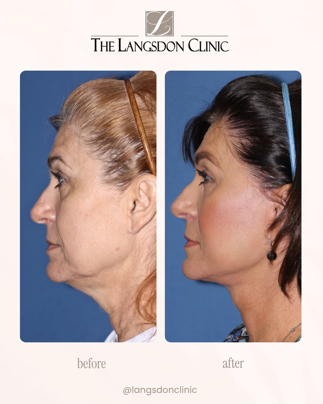 Instagram post by Dr. Phillip Langsdon: A beautiful Deep Plane Cheek Neck Lift result by Dr. Phillip Langsdon that left the patient still looking like herself, but more refreshed! …