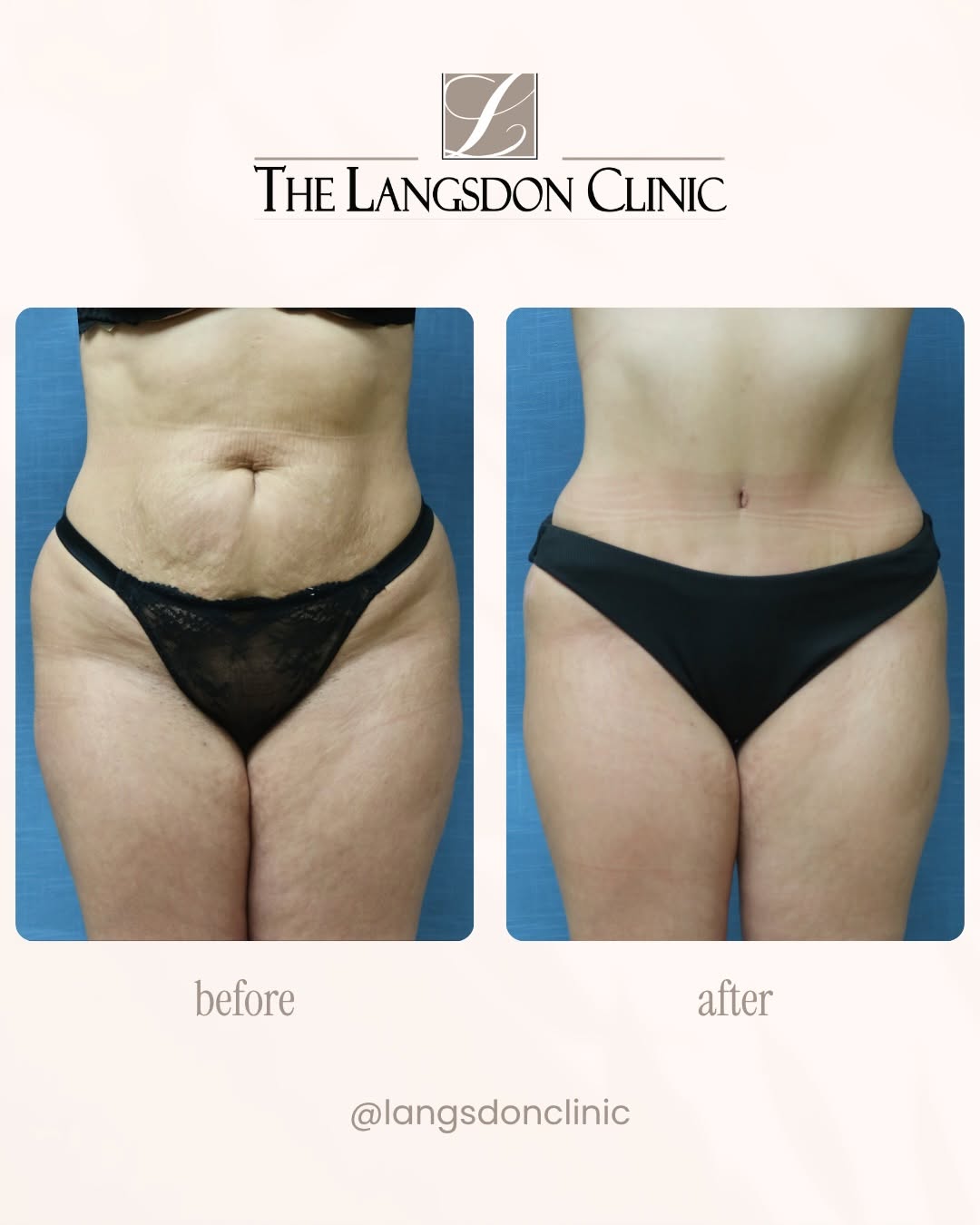 Instagram post by Dr. Phillip Langsdon: A beautiful Abdominoplasty result by Dr. Roberto Lachica! 👏 Our patient was in her 30’s and was finished having children, so she decided no…