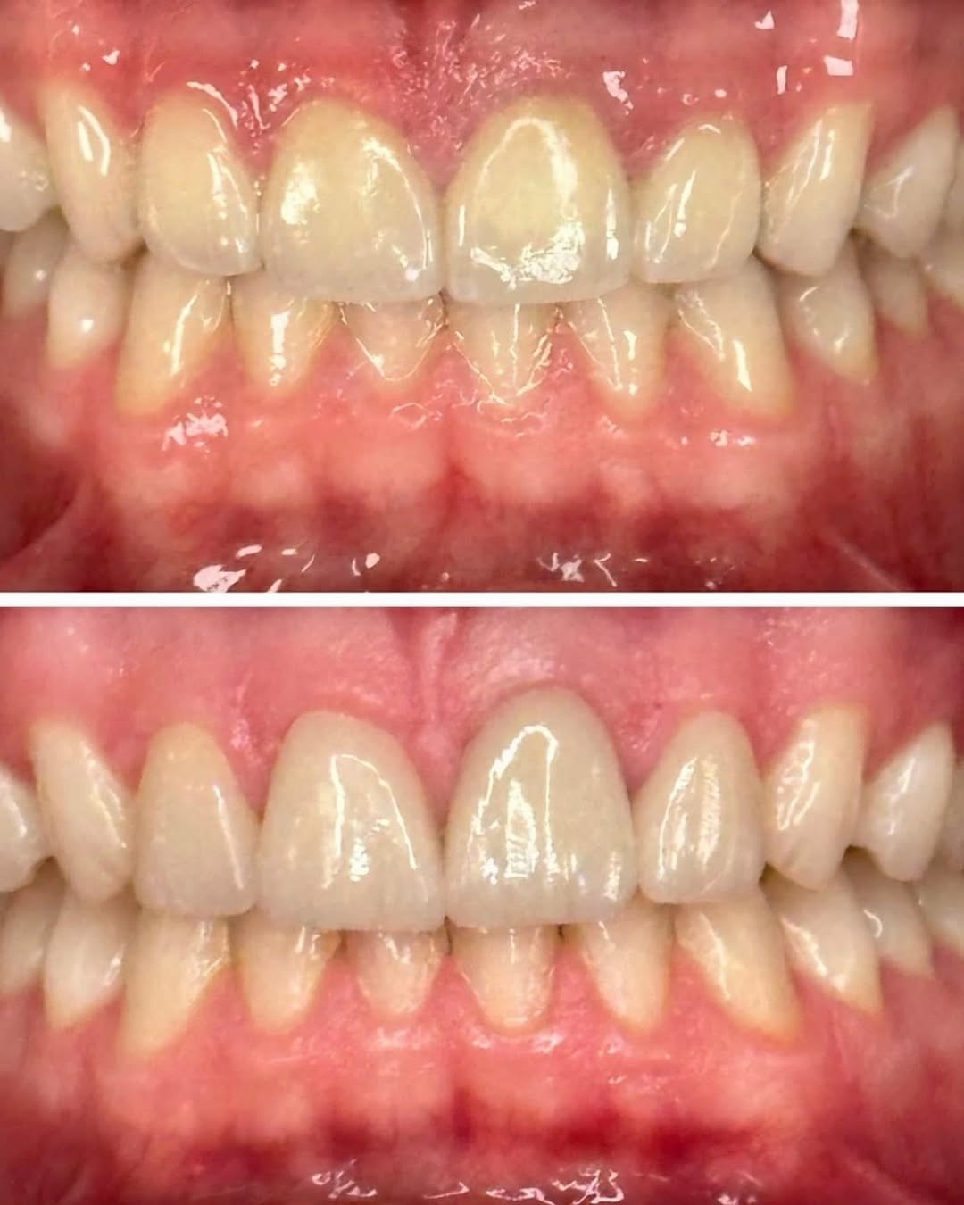Instagram post by Dr. Pia Lieb: She came to me already wearing veneers, but they were working against her, not for her: • Bulky and thick, so they looked stuck on instead o…