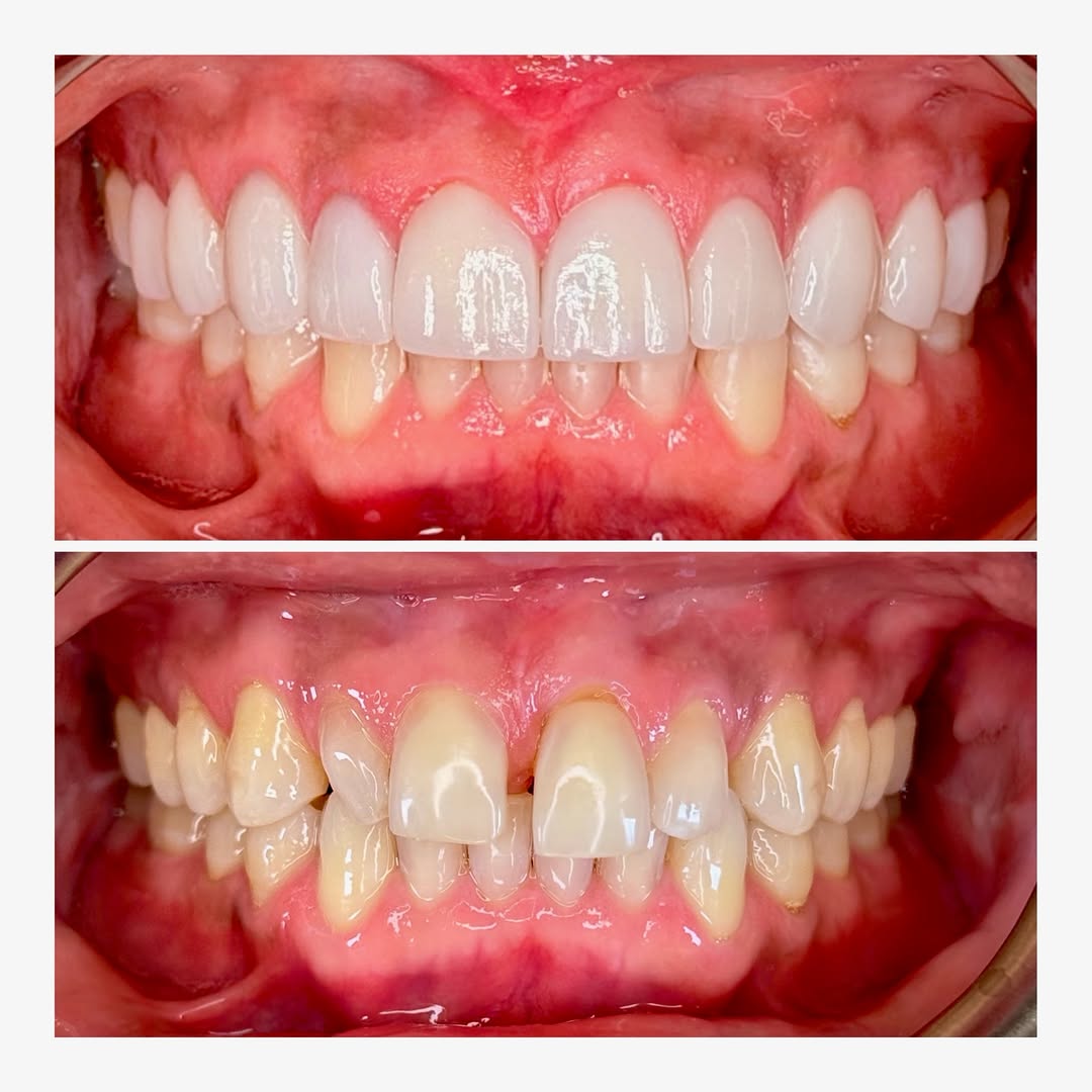 Instagram post by Dr. Pia Lieb: No drilling. No shaving. No compromise. Prepless veneers preserve the entire integrity of your natural tooth. Each veneer is handmade in por…