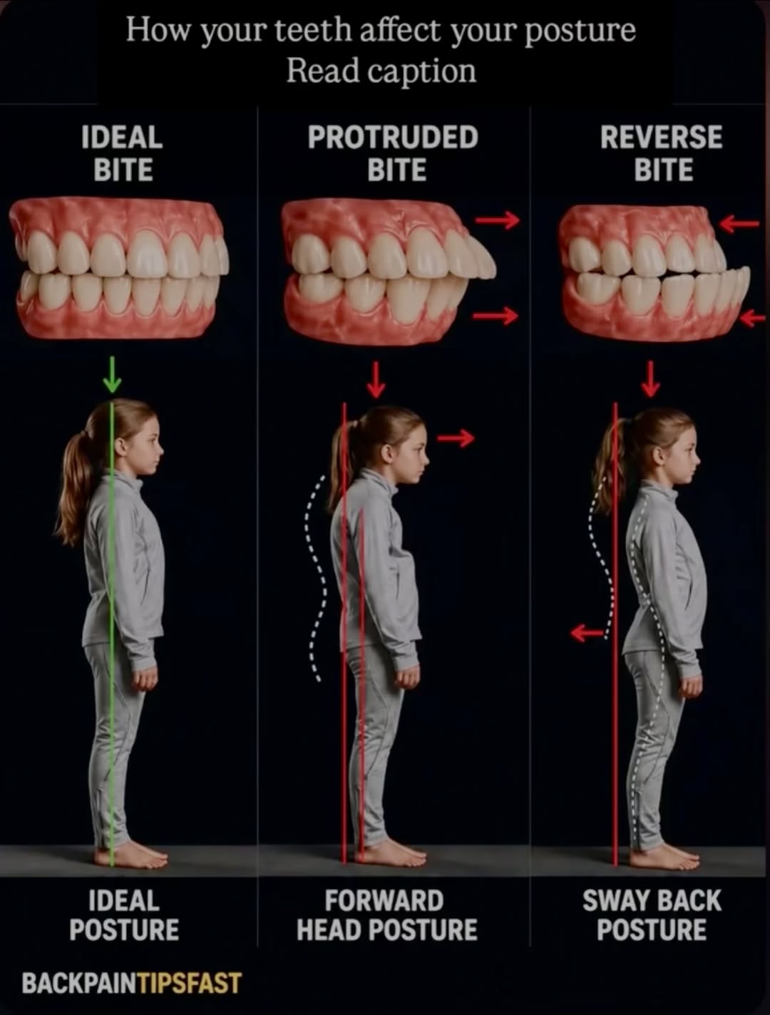 Instagram post by Dr. Pia Lieb: Your bite is quietly running your posture. Your bite does more than shape your smile. It shapes how you hold your entire body. The jaw sits …