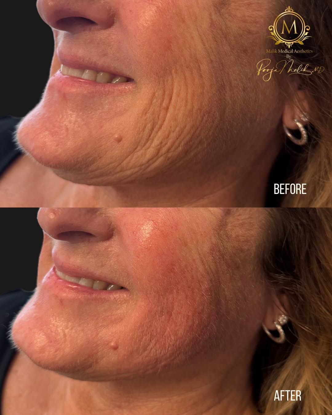 Instagram post by Dr. Pooja Malik: Subtle refinement, visible results ✨ This before & after showcases improved facial contour and a smoother, more refreshed appearance while m…