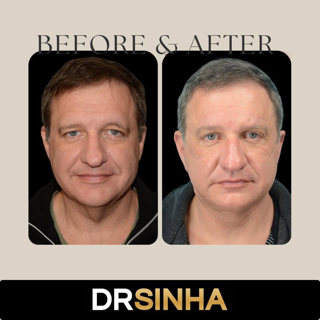 Instagram post by Dr. Pradeep K. Sinha: Opening up the eyes with a blepharoplasty can change the overall look of your face. This remarkable looks natural while still giving the pat…