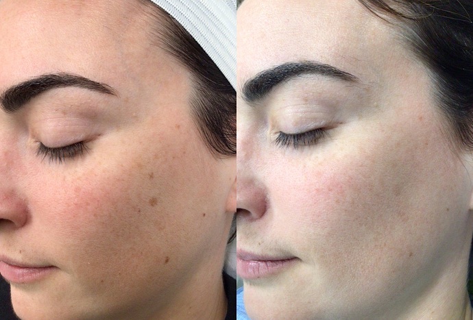 Instagram post by Dr. Pradeep K. Sinha: 👏🏽INTENSE 👏🏽PULSE 👏🏽LIGHT aka IPL 🫶🏽 The above before and afters are taken 6 weeks apart and the goal was to help get rid of brown s…