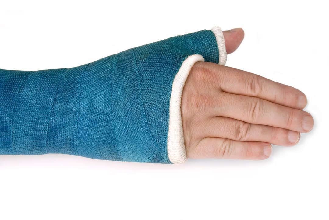 Instagram post by Dr. Pradeep S. Mohan: Scaphoid fractures require specialized care, and Veda Medical is here to support your recovery. Our experienced team uses advanced technique…