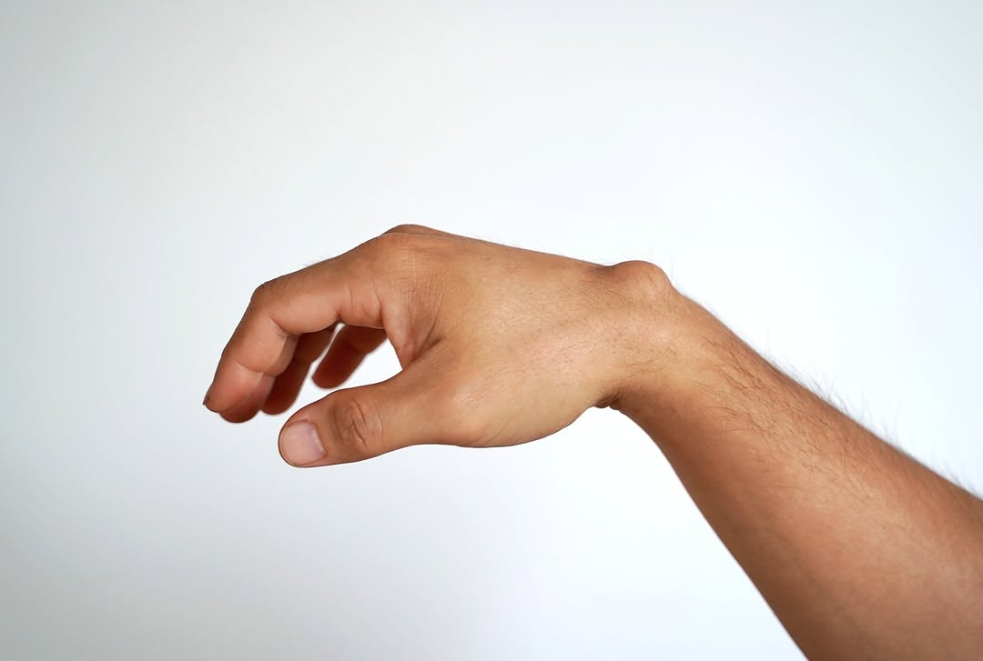 Instagram post by Dr. Pradeep S. Mohan: Find relief from ganglion cysts with the specialized care at Veda Medical. Our experienced team offers precise treatments to address cysts, …