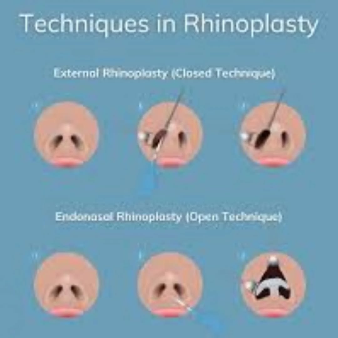 Instagram post by Dr. Prasad Kilaru: Rhinoplasty, or nose surgery, typically alters the nose's structure permanently, meaning the results usually last a lifetime. While normal a…