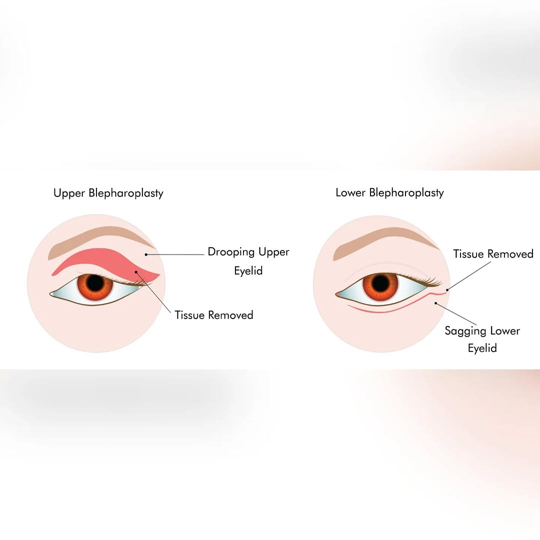 Instagram post by Dr. Prasad Kilaru: Blepharoplasty, also known as an eyelid lift, is a surgical procedure to improve the appearance of the eyelids by removing excess skin and/o…