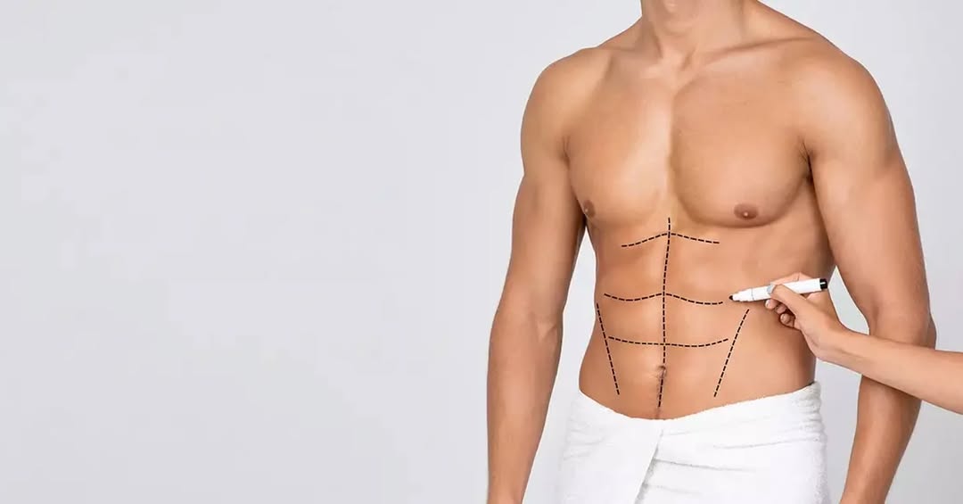 Instagram post by Dr. Prasad Kilaru: Abdominal contouring through liposuction, often re- ferred to as ab etching or six- pack surgery, is a cosmetic procedure that uses liposuc-…