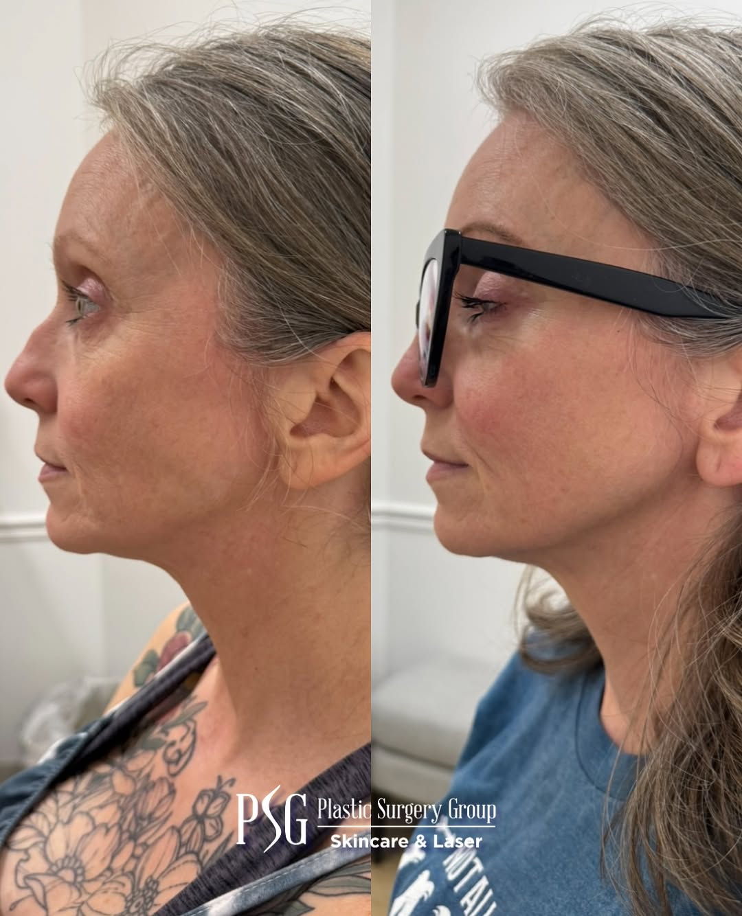 Instagram post by Dr. R. Louis Adams: Your botox routine might not need to stop at the forehead 👀 Can we take a moment for lower face tox?👏🏻 Instead of treating one specific a…