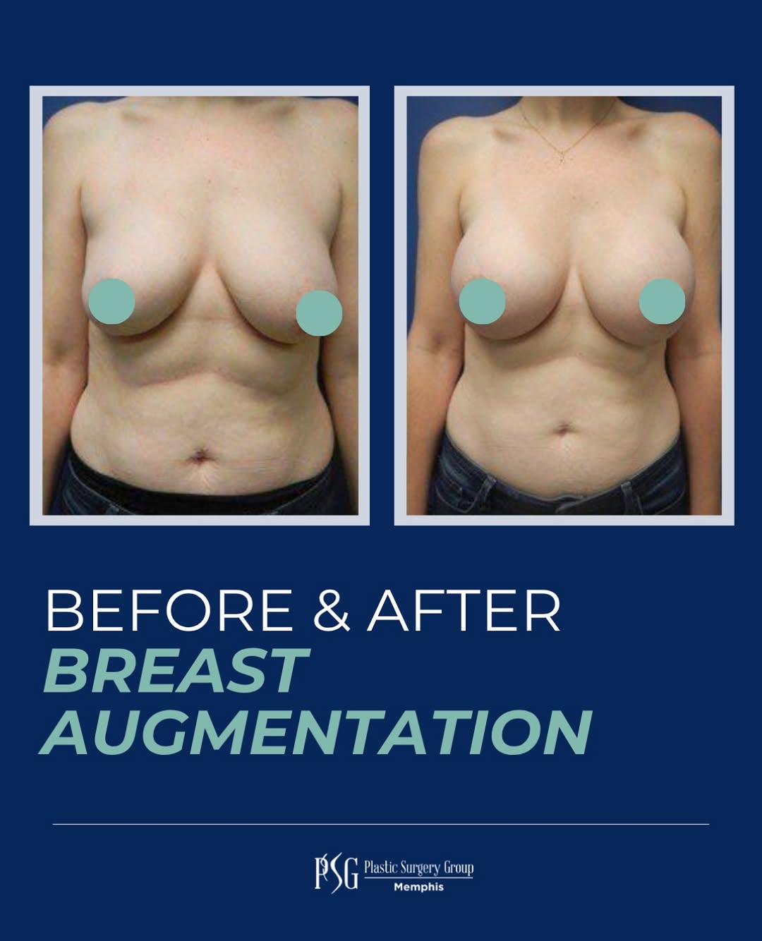 Instagram post by Dr. R. Louis Adams: Enhancing what’s already yours. ✨ A beautifully balanced breast augmentation designed to complement her natural shape and proportions. Ready…