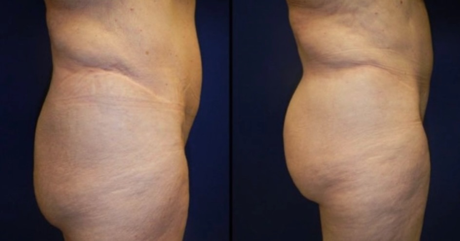 Instagram post by Dr. R. Louis Adams: A lift + a little volume in all the right places ✨ This patient underwent an excisional buttock lift paired with a brazilian butt lift for a…