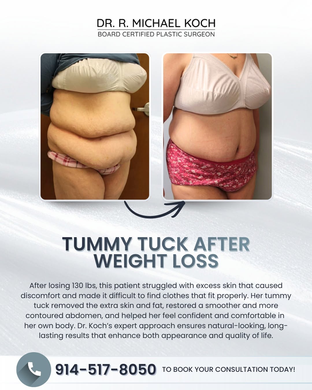 Instagram post by Dr. R. Michael Koch: Meet our amazing patient! 🌟 After losing 130 lbs from gastric sleeve surgery, she struggled with excess skin that caused discomfort and ras…