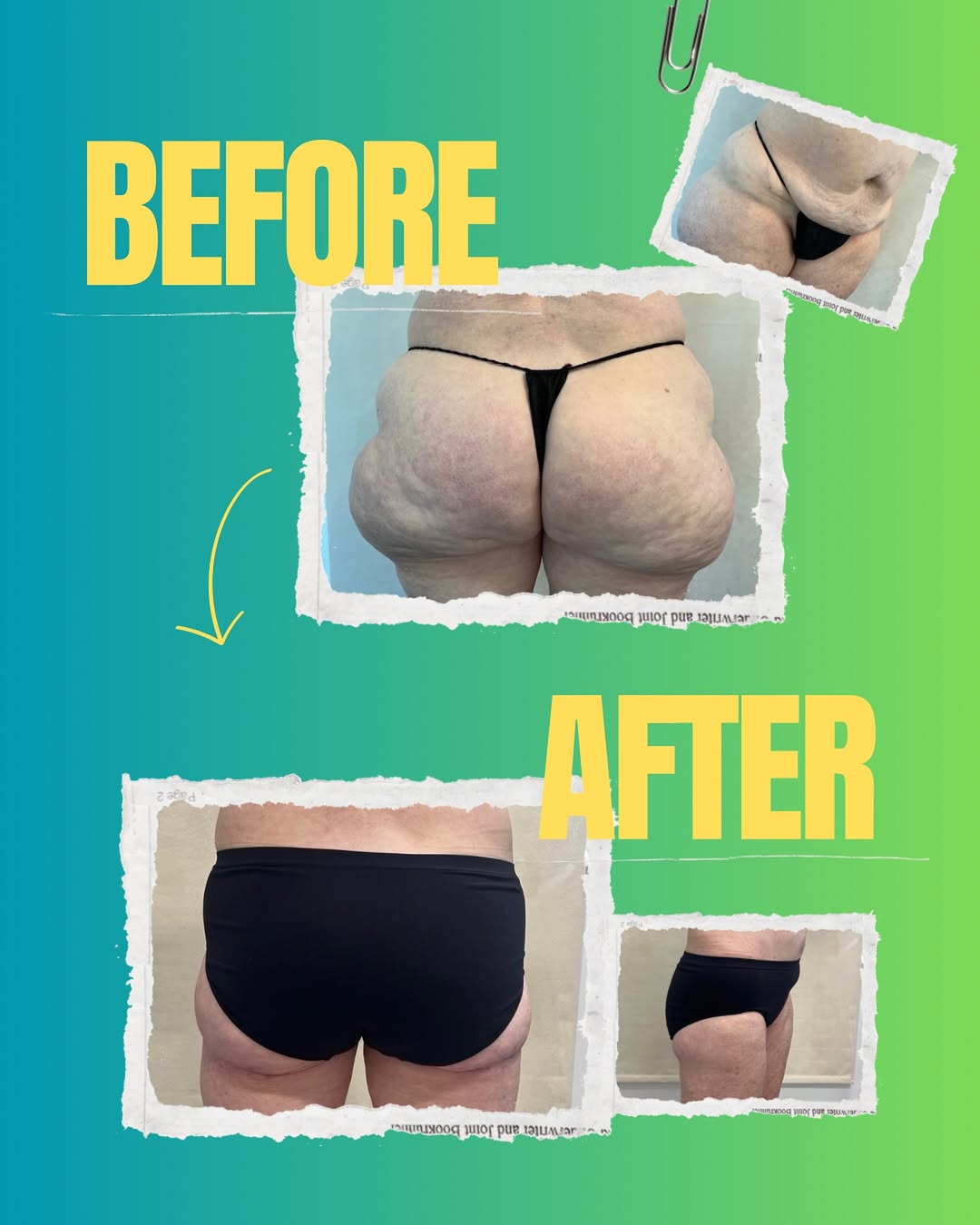 Instagram post by Dr. R. Morgan Davoudi: Transformation Through Precision 🍑 • • #bodycontouring #atlantaplasticsurgery #plasticsurgeon