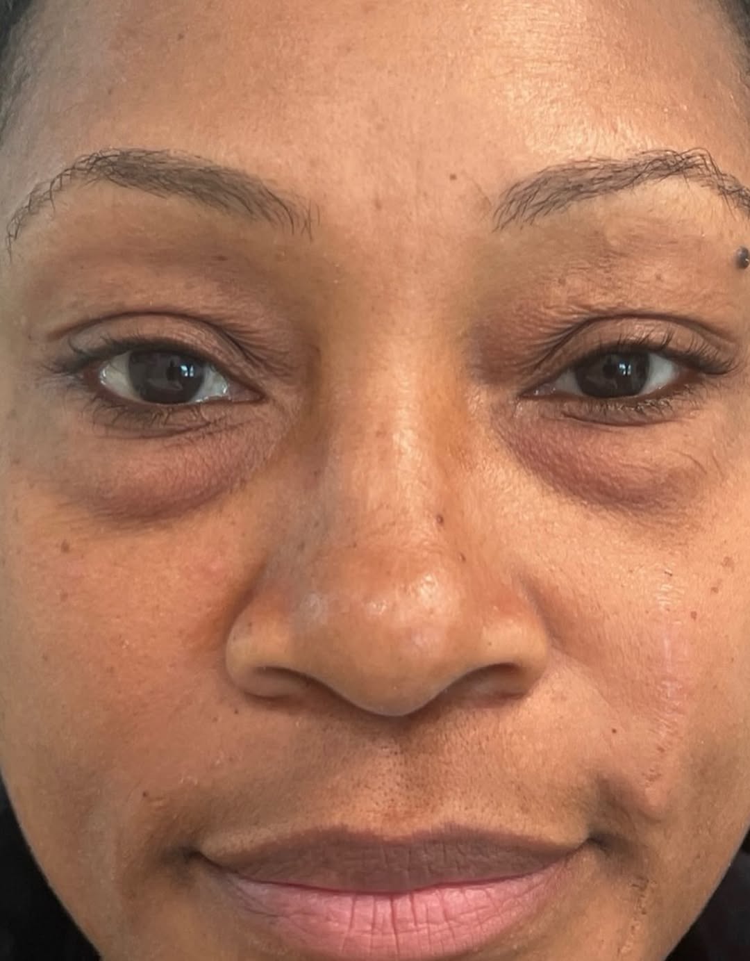 Instagram post by Dr. R. Morgan Davoudi: This beautiful patient shared her results from her lower eyelid blepharoplasty, she’s almost at her year mark and loving her results! She is…
