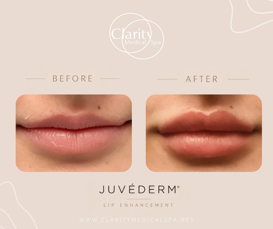 Instagram post by Dr. Rachel Dunn-Black: ✨ REMINDER: JUVÉDERM® DAY IS TOMORROW! ✨ A little volume. A little definition. A whole lot of confidence. 💋💋✨ We love a soft, natural-look…