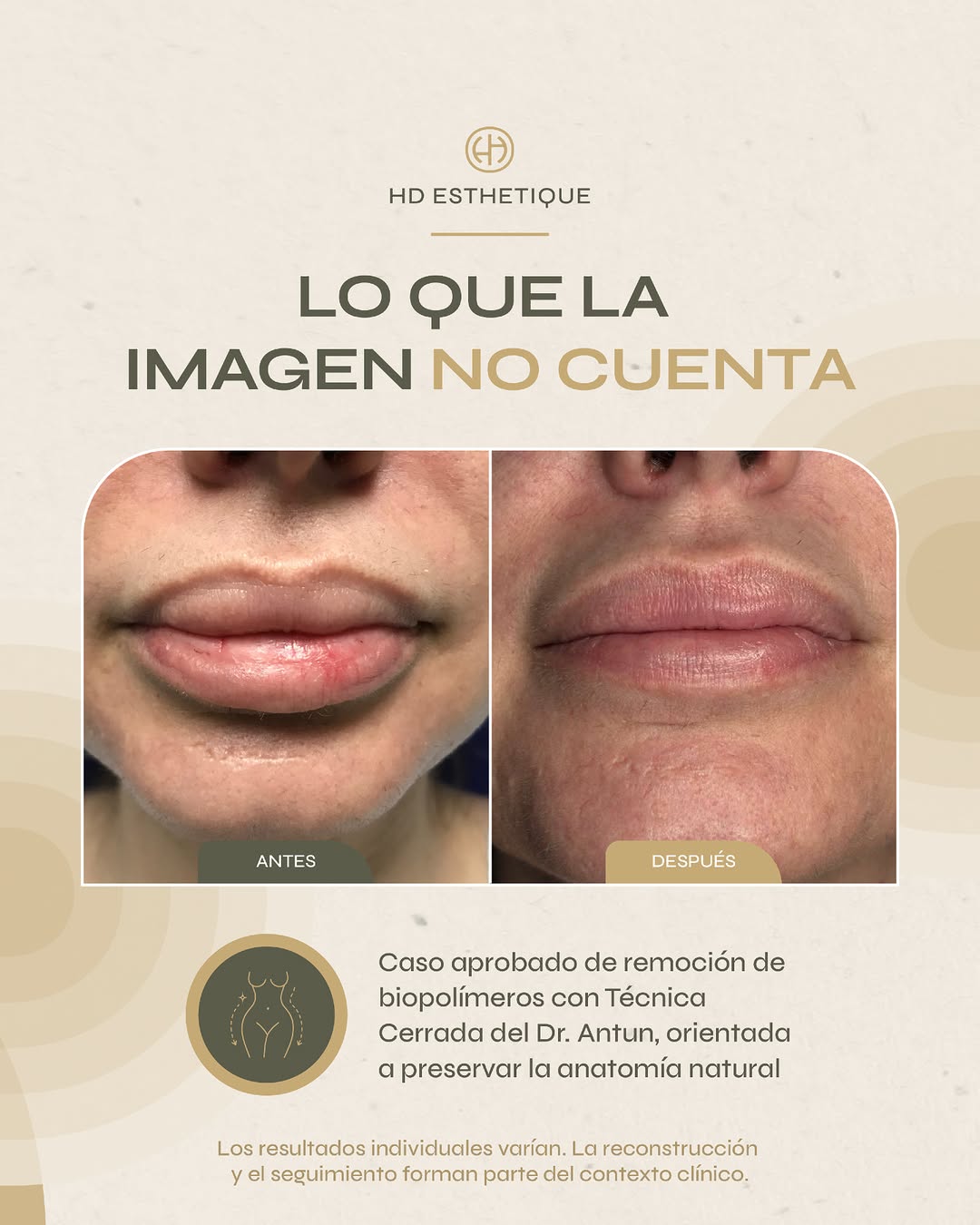 Instagram post by Dr. Rafael Antun: Un antes y después de biopolímeros nunca debe presentarse sin contexto médico. En este caso autorizado, el resultado refleja una remoción es…