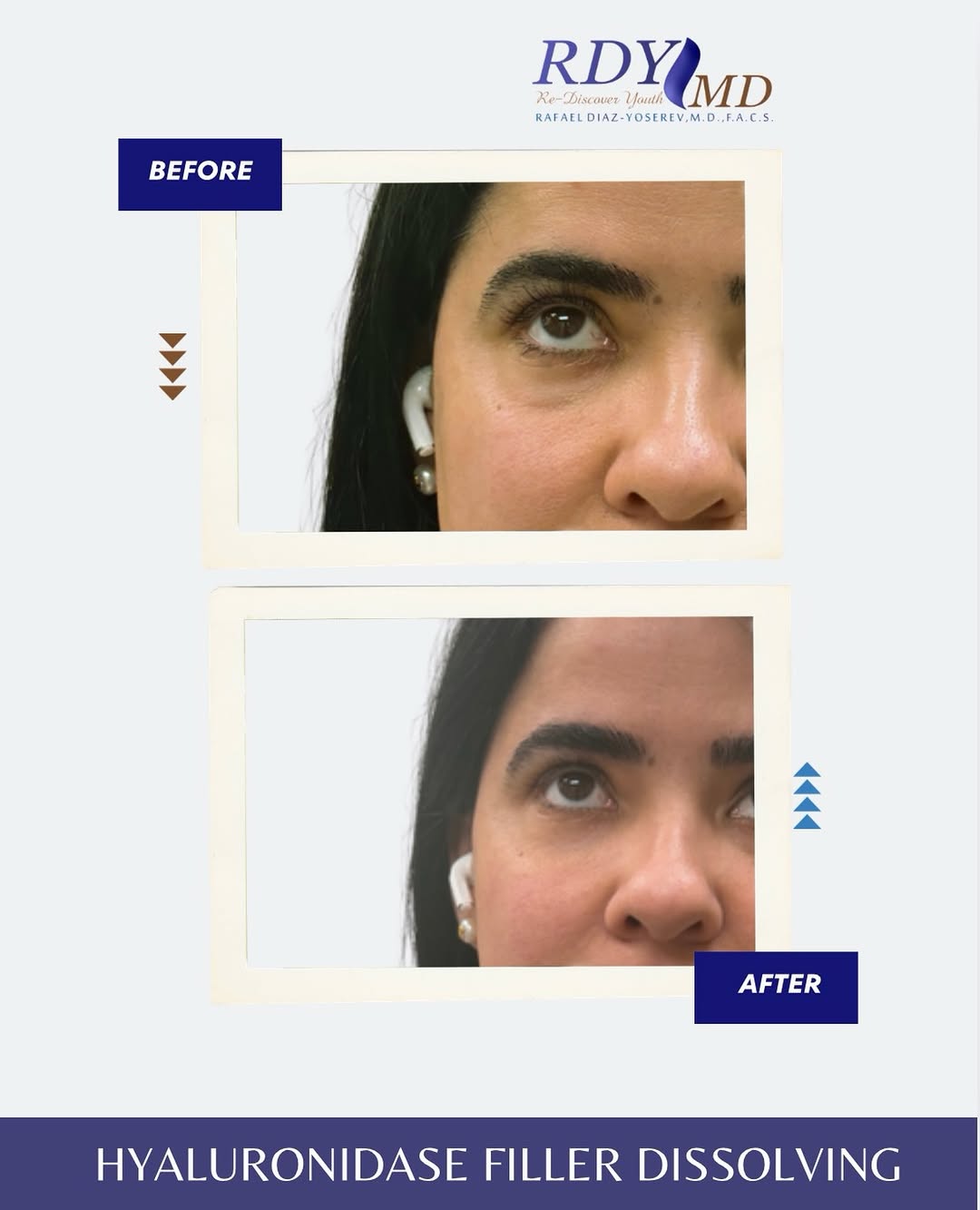 Instagram post by Dr. Rafael Diaz-Yoserev: ✨ When less is more. This patient previously had filler placed by another provider in different areas of the face. She came to me to dissolv…