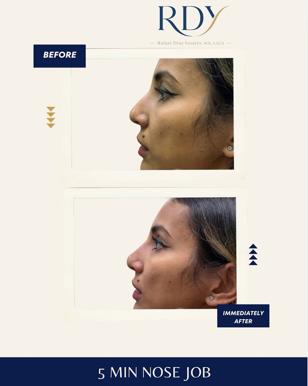 Instagram post by Dr. Rafael Diaz-Yoserev: 👨⚕️ Dr Rafael Diaz Yoserev, MD,FACS 😷Treatment/Procedure: Non-surgical 5 min nose job ✅Purpose: To create a shapelier, more balanced and …