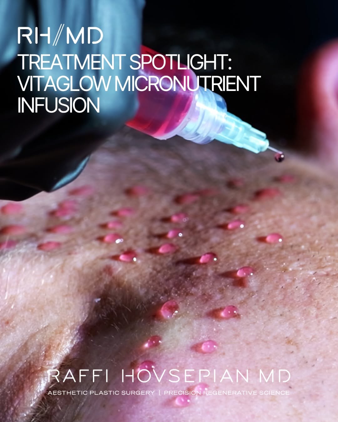 Instagram post by Dr. Raffi Hovsepian: Treatment Spotlight: VitaGlow Micronutrient Infusion The modern glow treatment is no longer just about surface radiance. It is about feeding…