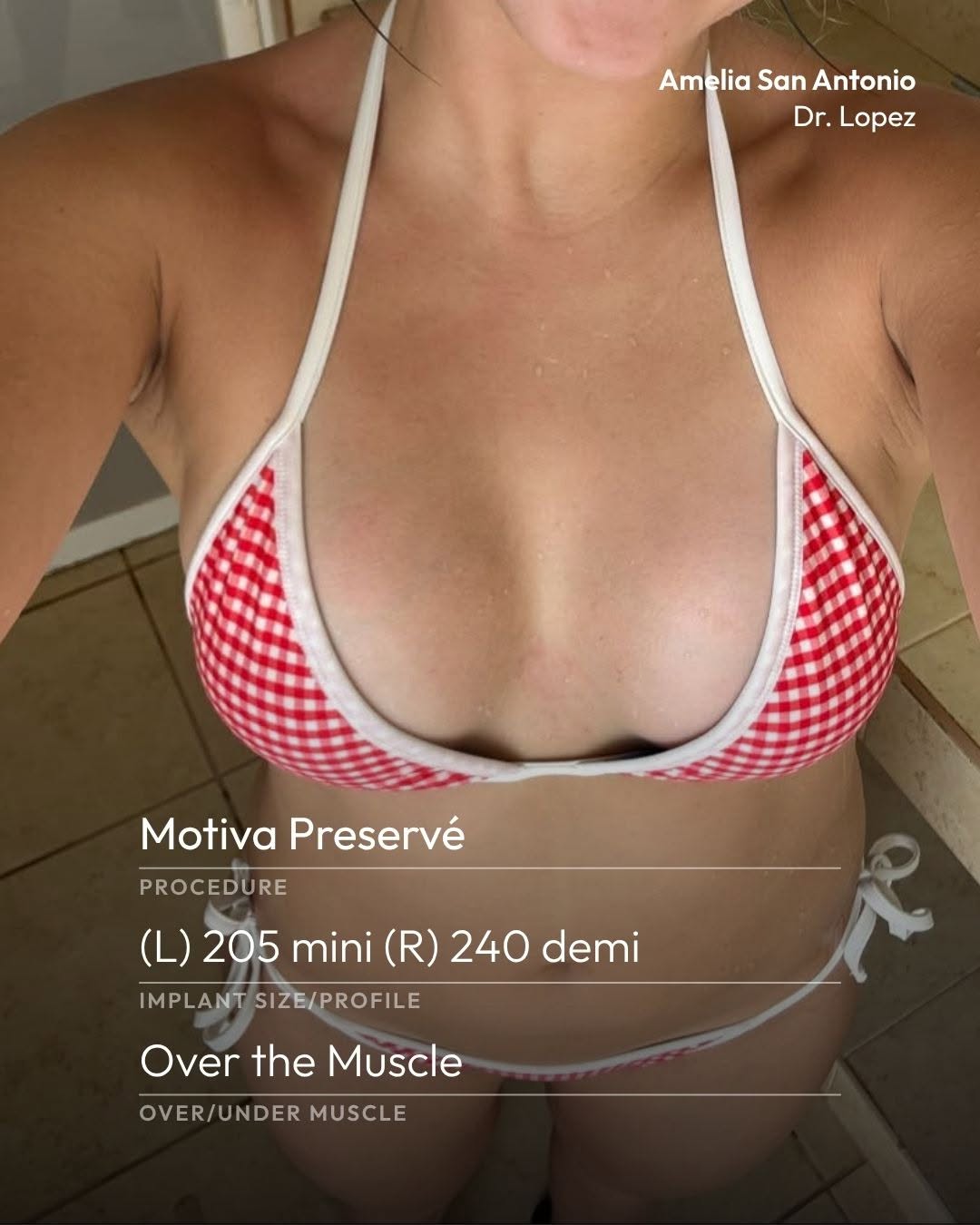 Instagram post by Dr. Rafi Fredman: Looking for less downtime after your breast augmentation? See what this patient had to say about her experience with Preservé! 👇 "I hit 4 w…
