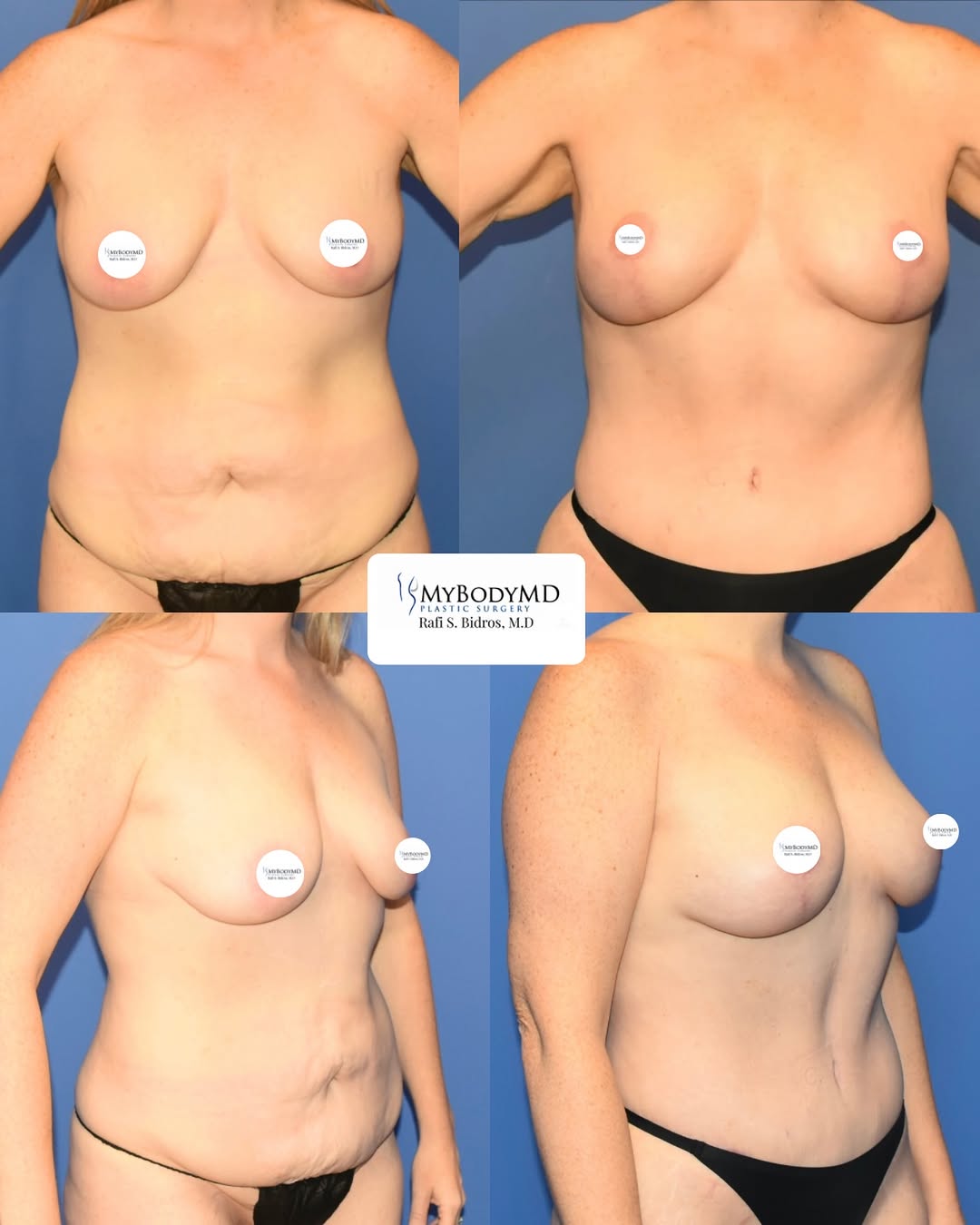Instagram post by Dr. Rafi S. Bidros: This mommy makeover is more than a transformation— it’s a comeback. 🔥 Tighter tummy ✔️ Lifted, fuller shape ✔️ Confidence on 💯 Your body a…