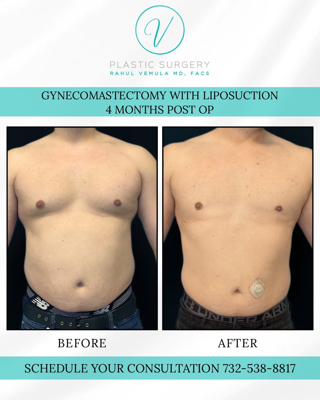 Instagram post by Dr. Rahul Vemula: A subtle change can make a lasting impact. This patient is 4 months post-op following gynecomastia surgery with liposuction, revealing a mor…